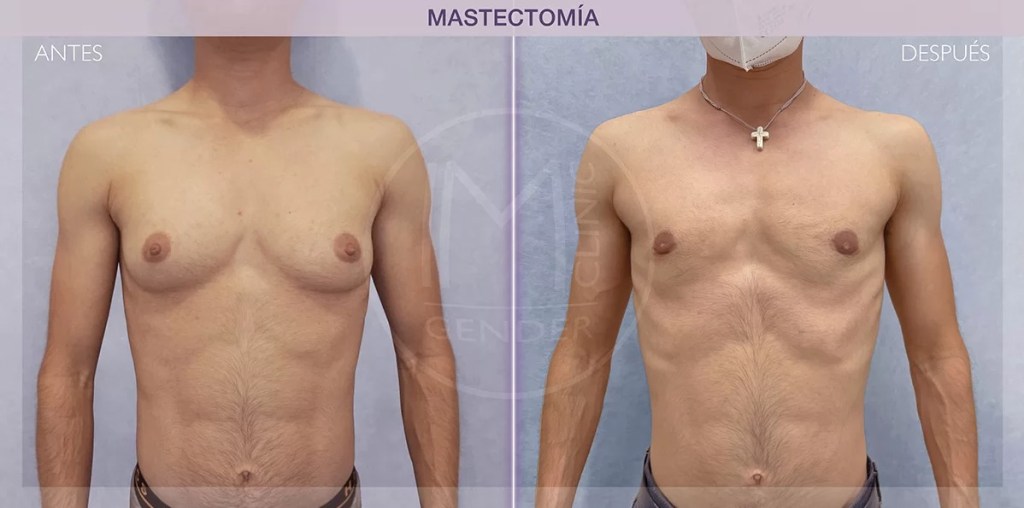 cirugía de afirmación de género - trans - masectomia