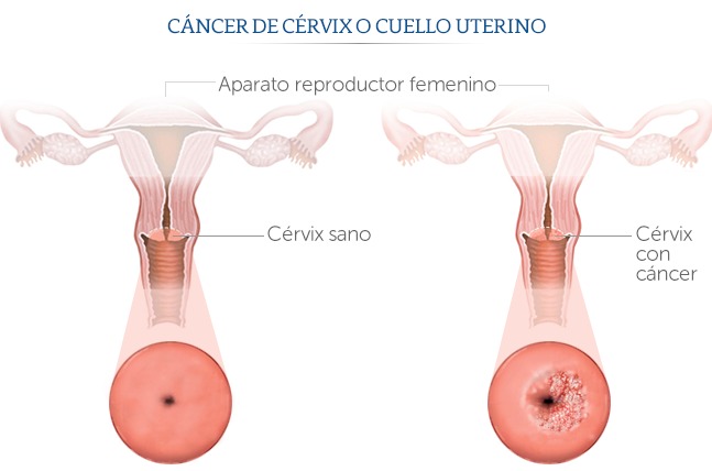 cáncer cervicouterino VPH mujeres