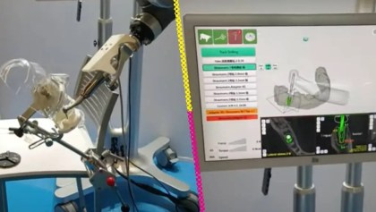 Yakebot, el primer robot dentista